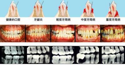 镶牙是怎么镶的(镶牙有几种方法)-第1张图片-