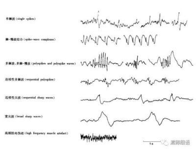 脑电图异常放电怎么办？脑电图怎么看是不是异常放电-第1张图片-