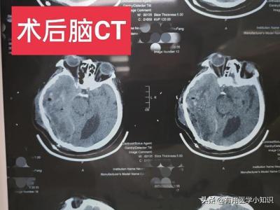 脑部肿瘤的手术的费用多少(脑部肿瘤手术费用多少钱)-第2张图片-